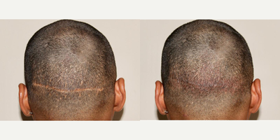 Scalp Micropigmentation before and after photo