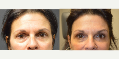 Botox before and after photo