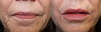 Belotero before and after photo