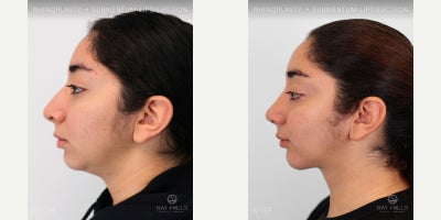 Chin Liposuction before and after photo