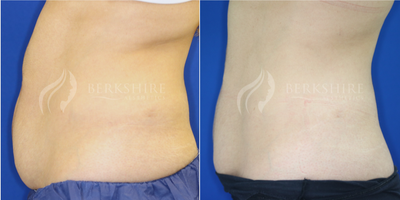 CoolSculpting before and after photo