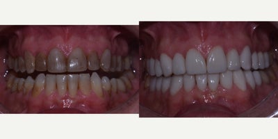 Porcelain Veneers before and after photo