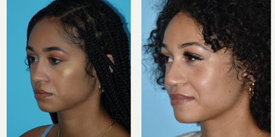 Rhinoplasty before and after photo