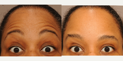 Botox before and after photo