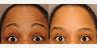 Botox before and after photo