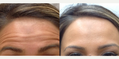 Botox before and after photo