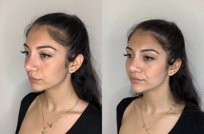 Chin Filler before and after photo