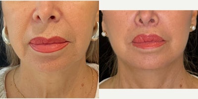 Lip Lift before and after photo