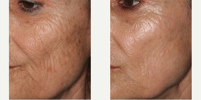 Microneedling before and after photo