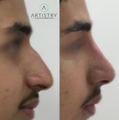 Nonsurgical Nose Job before and after photo