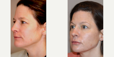 RHA Collection Fillers before and after photo