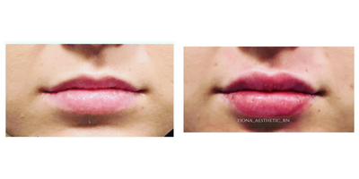 Vollure before and after photo