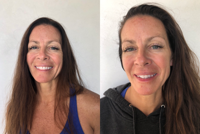 Dermal Fillers before and after photo