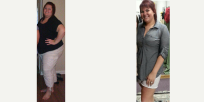 Gastric Sleeve Surgery before and after photo