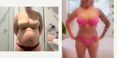 Mommy Makeover before and after photo
