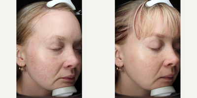 Pulsed Dye Laser before and after photo