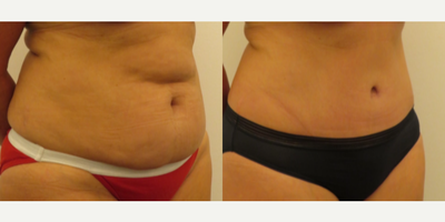 Tummy Tuck before and after photo