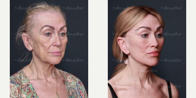 Deep Plane Facelift before and after photo