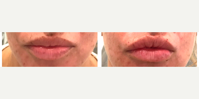 Lip Fillers before and after photo