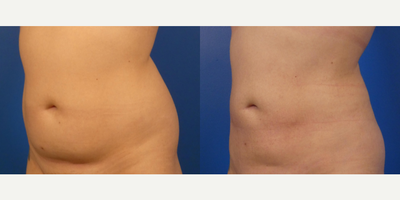 Liposuction before and after photo