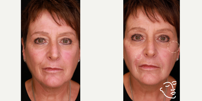 Liquid Facelift before and after photo