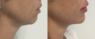 Chin Filler before and after photo