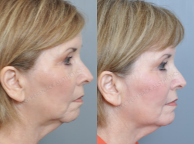 Chin Implant before and after photo