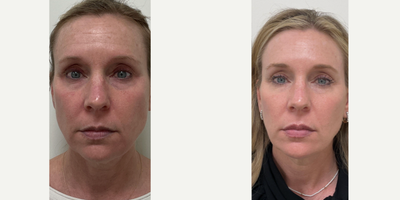 Juvederm before and after photo