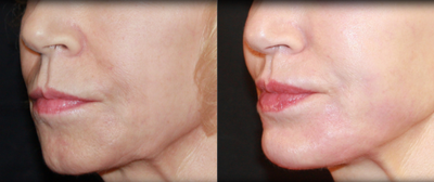 Restylane before and after photo