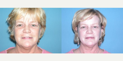 Skin Rejuvenation before and after photo