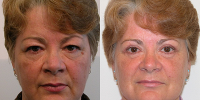 Eyelid Surgery before and after photo