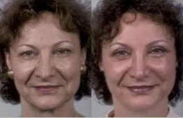 Facelift before and after photo