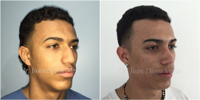 Rhinoplasty before and after photo