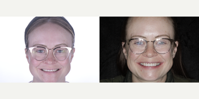 Smile Makeover before and after photo