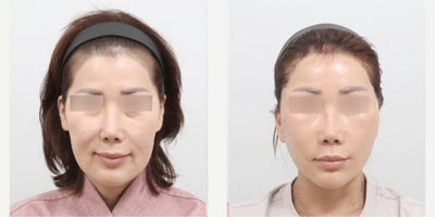 Brow Lift before and after photo