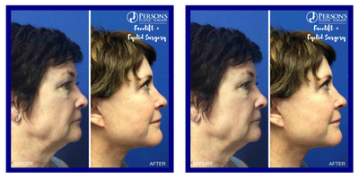 Facelift before and after photo
