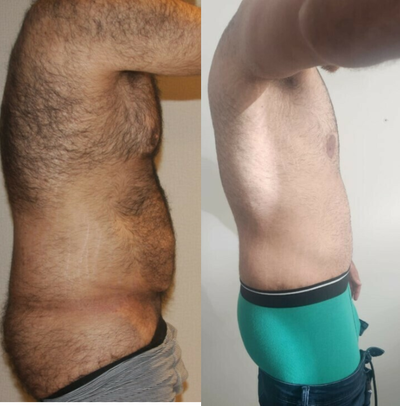 Gynecomastia Surgery before and after photo