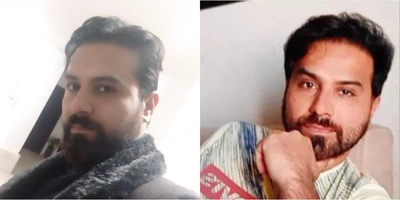 Hair Transplant before and after photo