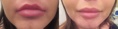Lip Fillers before and after photo