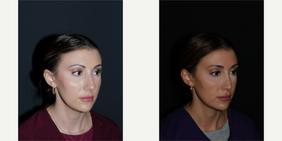 Rhinoplasty before and after photo