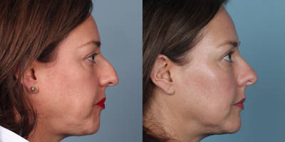 Rhinoplasty before and after photo