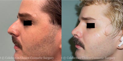 Rhinoplasty before and after photo