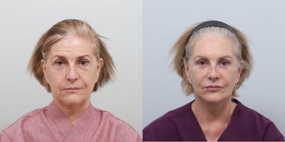 Deep Plane Facelift before and after photo