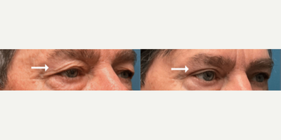 Eyelid Surgery before and after photo