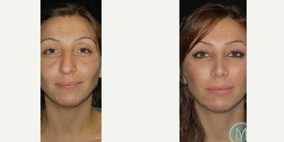 Liposuction before and after photo
