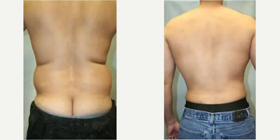 Liposuction before and after photo