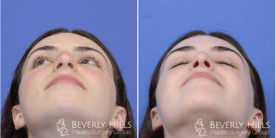Rhinoplasty before and after photo