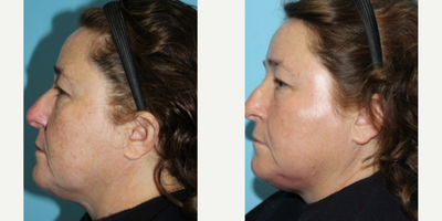 Chemical Peel before and after photo