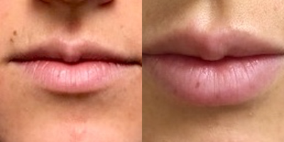 Dermal Fillers before and after photo