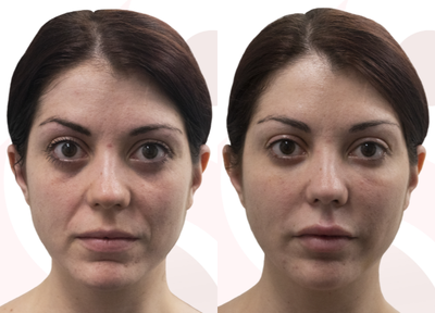 Dermal Fillers before and after photo